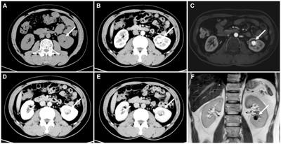 A tumor-like renal arteriovenous malformation on 18F-PSMA-1007 PET/CT: a case report